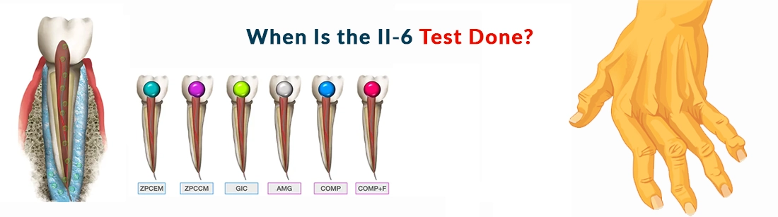 When Is the Il-6 Test Done